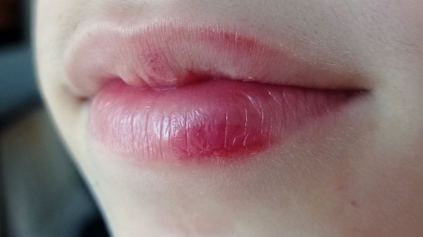 Por qué tengo una calentura en la boca