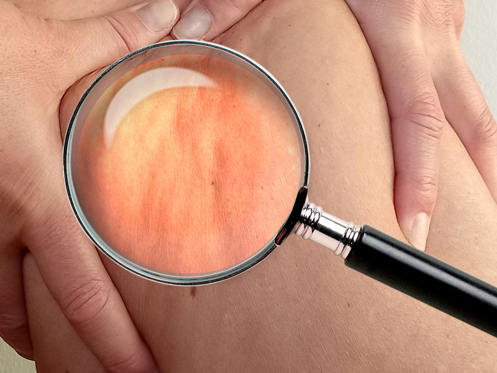 cómo eliminar la celulitis de muslos, glúteos y abdomen