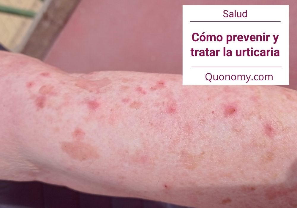 cómo prevenir la urticaria