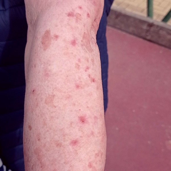 Cómo prevenir la urticaria y qué remedios pueden aliviar la picazón