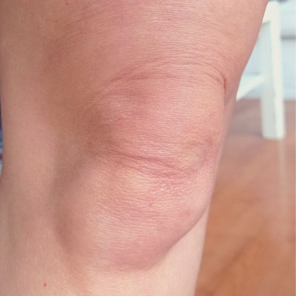 Cómo prevenir las arrugas en las rodillas (y tratamientos para eliminarlas)