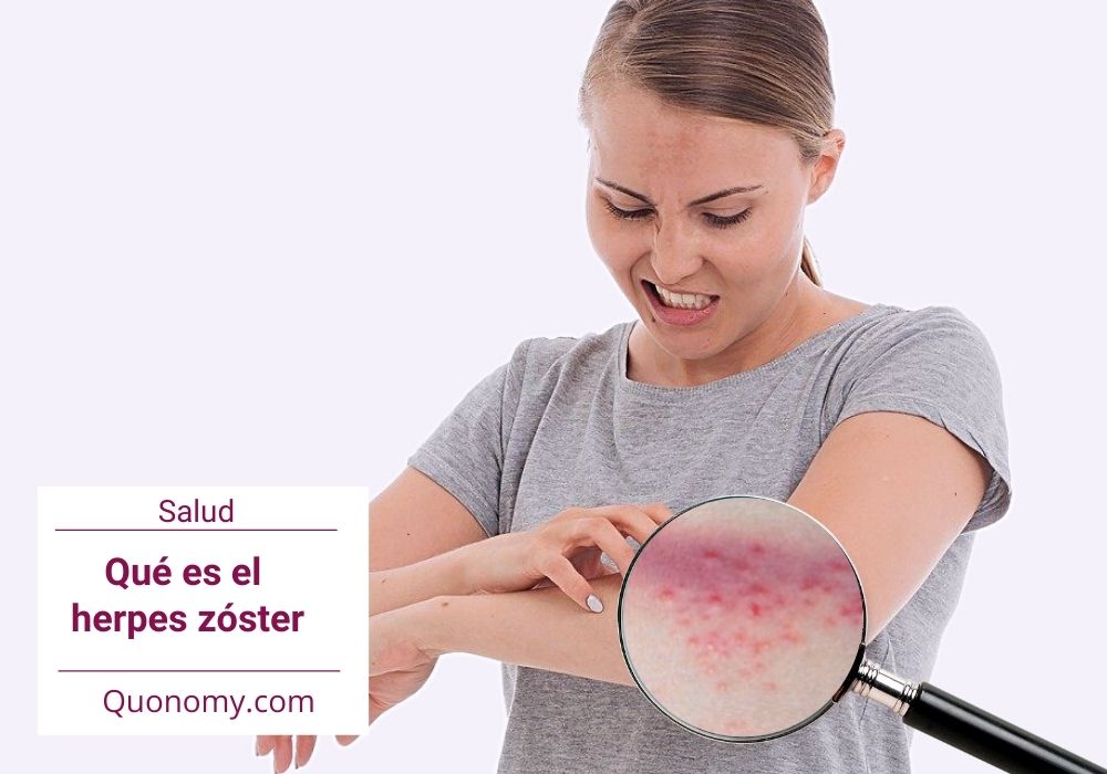 herpes zóster, qué es y cuáles son sus síntomas
