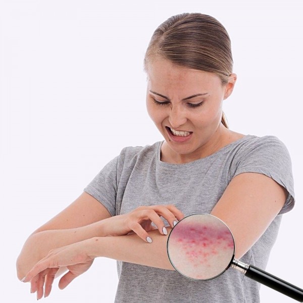 Qué es el herpes zóster o culebrilla