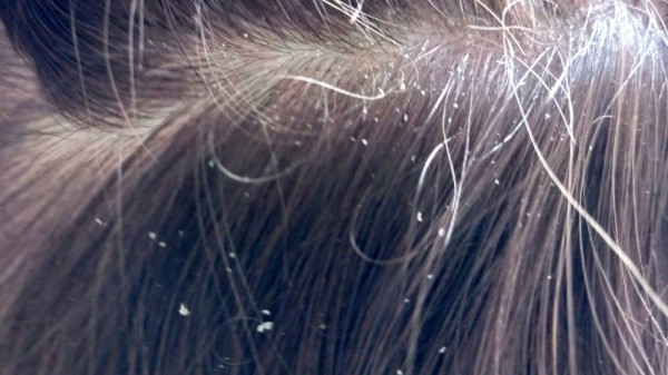 ¿La caspa puede provocar caída del cabello?