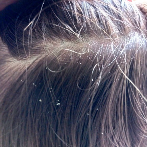 ¿La caspa puede provocar caída del cabello?