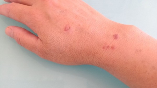 ¿Cómo aliviar una quemadura de cocinar? Remedio infalible con aceites esenciales