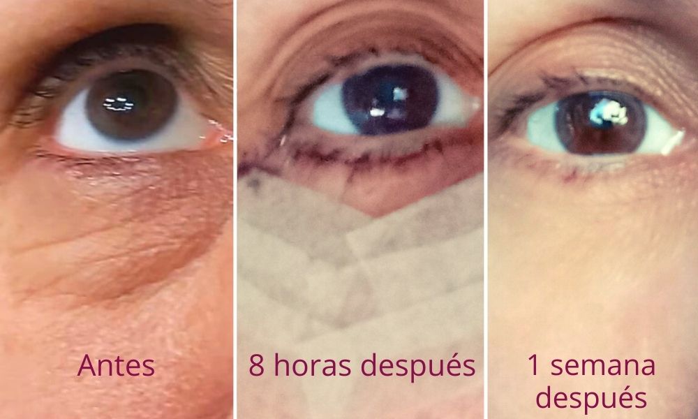 Blefaroplastia inferior paso a paso
