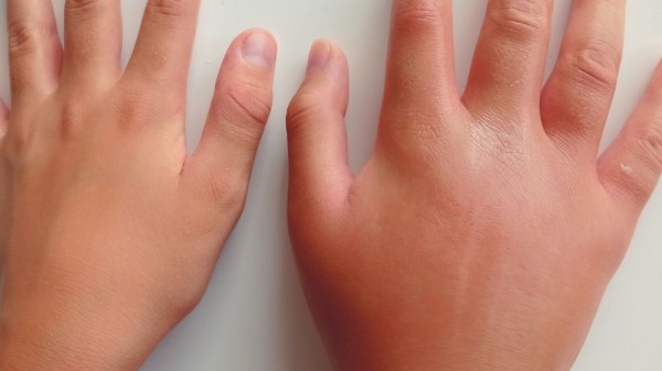 ¿Qué bicho te ha picado? Aprende a reconocerlo y a aliviar la molestia