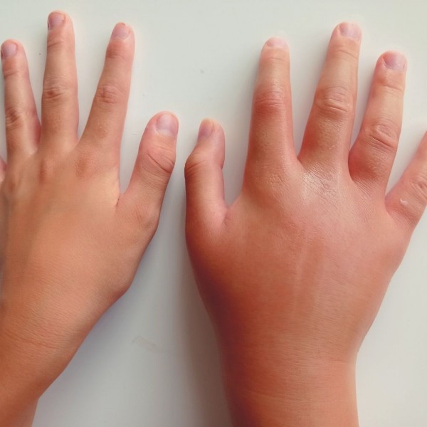 ¿Qué bicho te ha picado? Aprende a reconocerlo y a aliviar la molestia