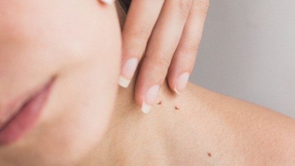 Verrugas en el cuello y axilas: ¿por qué aparecen y cómo eliminarlas?