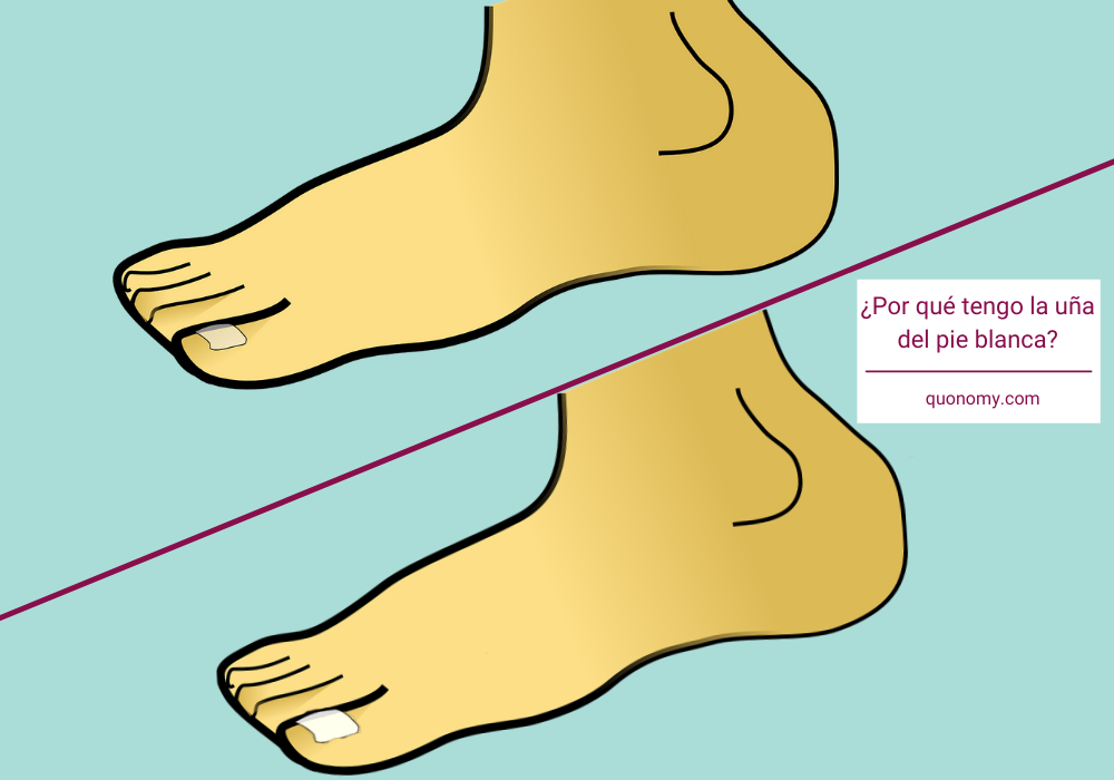 por qué las uñas de los pies se ponen blancas