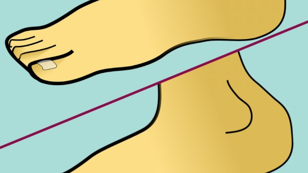 ¿Por qué las uñas de los pies se ponen blancas?