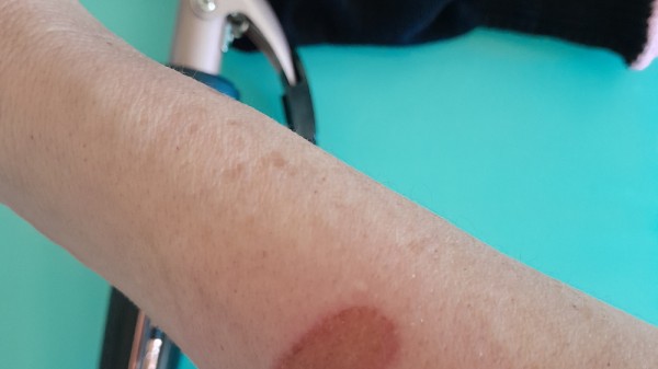 Cómo tratar una quemadura del rizador o la plancha del pelo