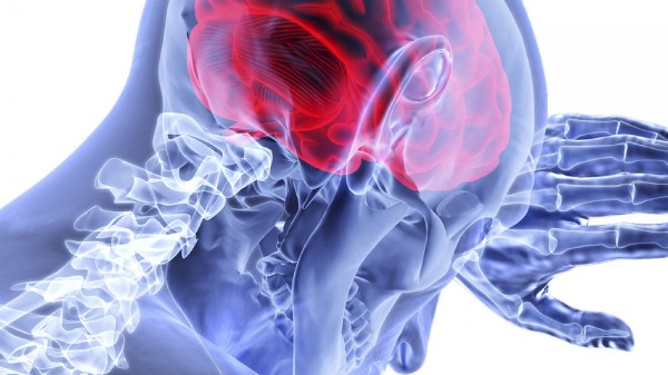 Por qué se produce un ictus. 10 causas del ictus isquémico y hemorrágico