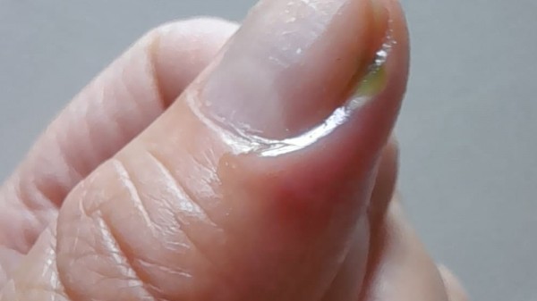 Uñero en un dedo de la mano, ¿qué hacer para curar una uña infectada?