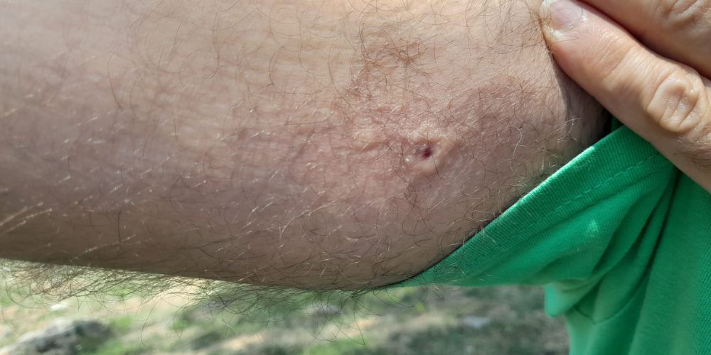 así es una picadura de tábano