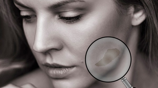 Por qué tengo manchas oscuras en la cara