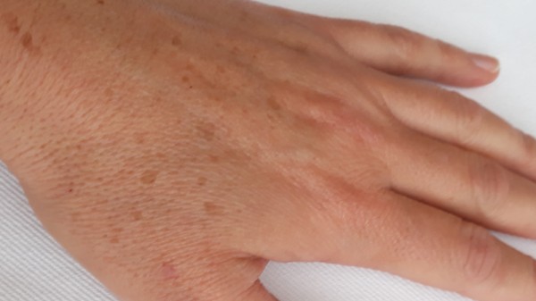 Cómo eliminar las antiestéticas manchas de las manos. Remedios caseros