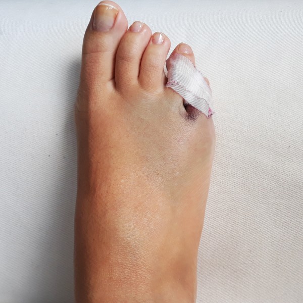 Fractura del dedo meñique del pie: síntomas y tratamiento