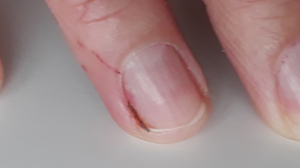 Cómo sacar una astilla de la uña con distintos métodos