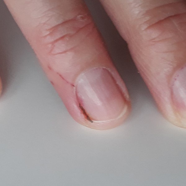 Cómo sacar una astilla de la uña con distintos métodos