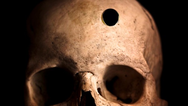 Cómo se operaba el cerebro en la antigüedad