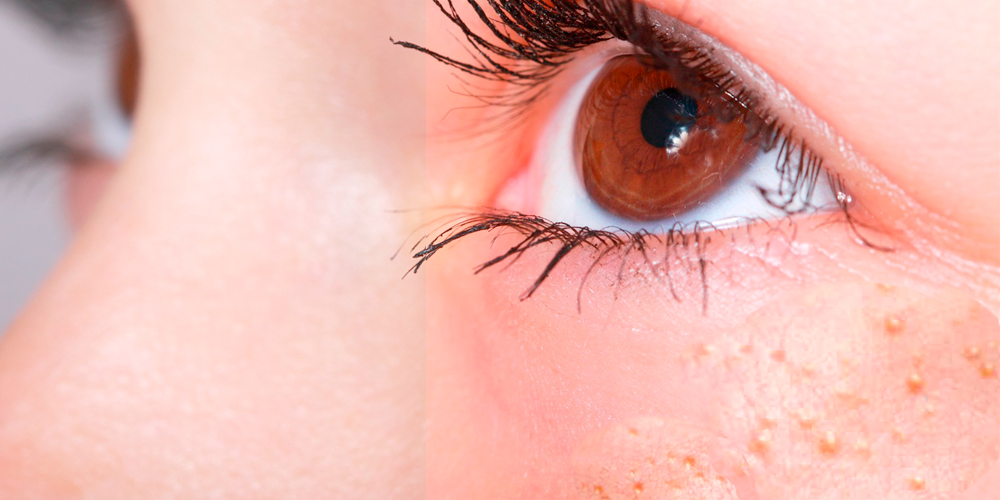 bultos blancos en la cara